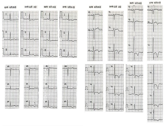 心電図 時系列