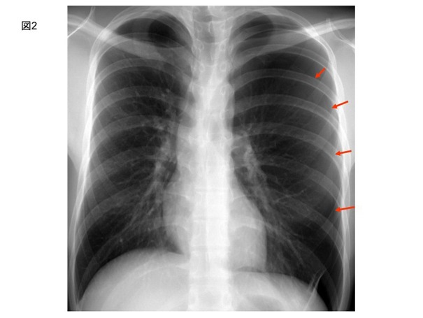 胸部レントゲン写真