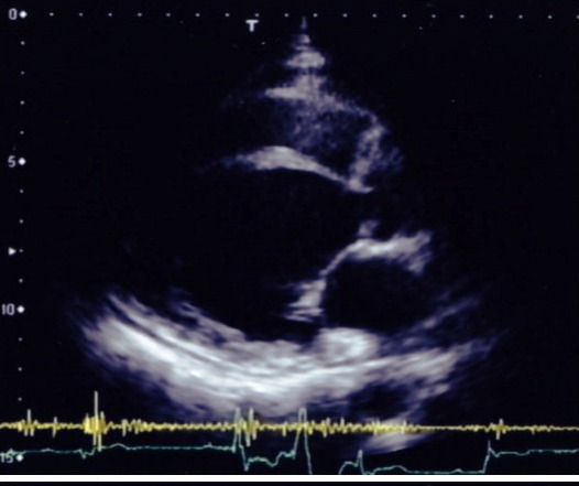 画像:心エコー