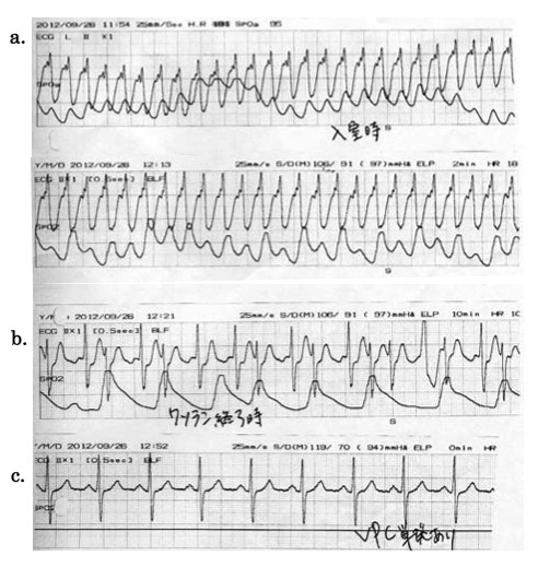 図2 モニター心電図