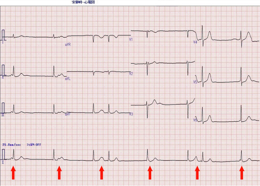 問題の心電図