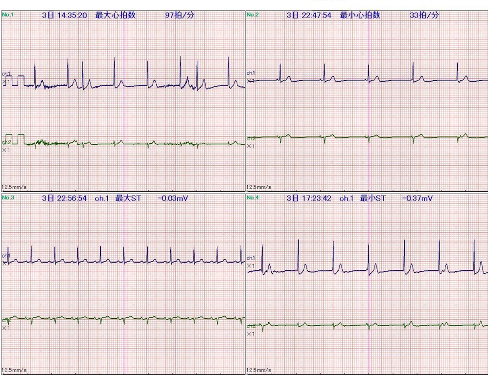 ホルター心電図1