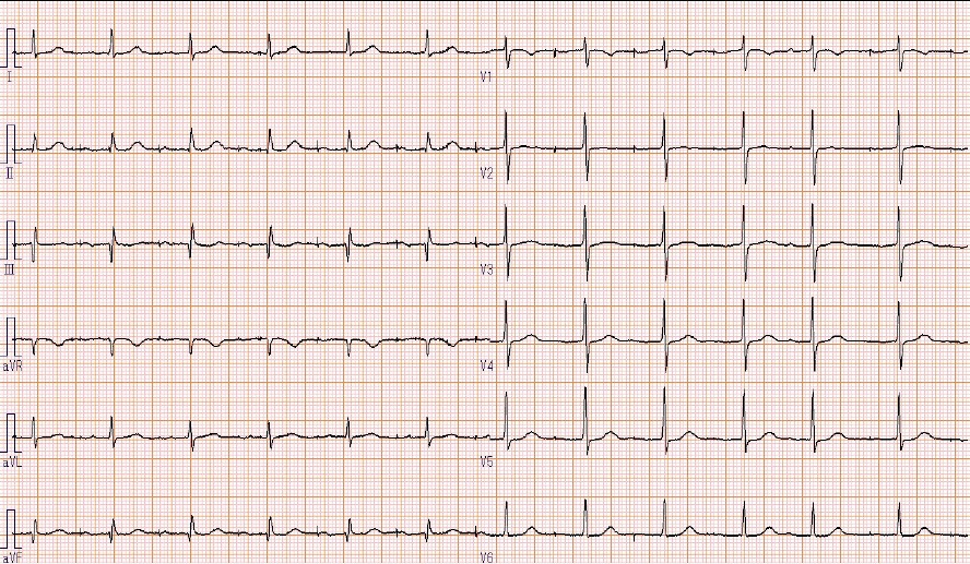 3ヶ月前の心電図