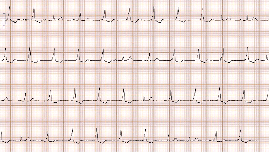外来受診時の心電図